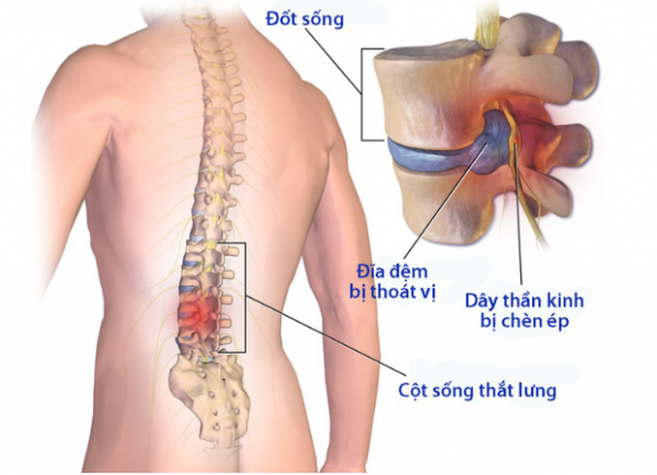 BỆNH THOÁT VỊ ĐĨA ĐỆM CỘT SỐNG THẮT LƯNG