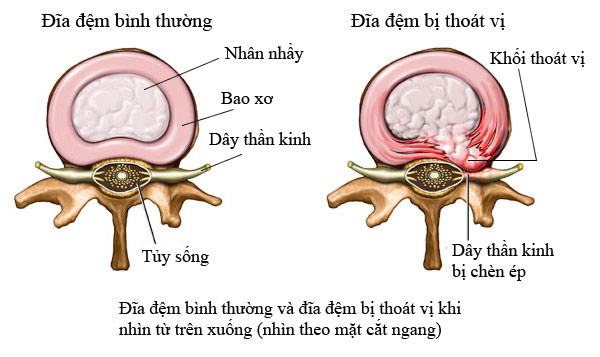 Description: Vi cấu trúc và sinh hóa của đĩa đệm