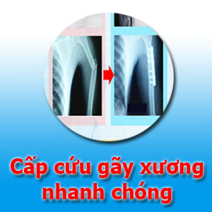 Cấp cứu gãy xương nhanh chóng