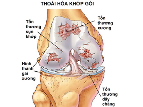 THOÁI HÓA KHỚP GỐI: BẠN BIẾT GÌ VỀ BỆNH NÀY?